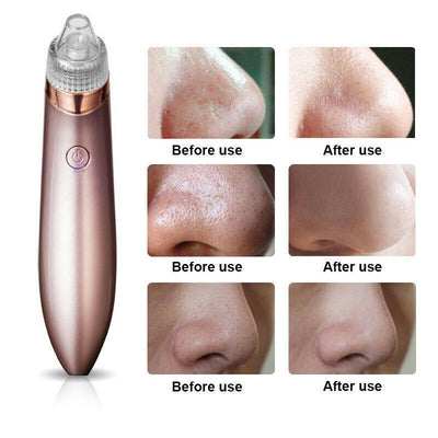 Electric Blackhead & Pore Vacuum Cleaner – Strong Suction Acne & Pimple Remover with Diamond Dermabrasion for Facial Skin Care